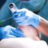 Bougies for all intubations led to high success rates, even on difficult airways