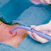 Comparison of outcomes between vertical and transverse skin incisions in percutaneous tracheostomy for critically ill patients