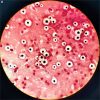 Cryptococcus Neoformans Meningoencephalitis