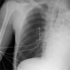 Doubling Down on Re-Expansion Pulmonary Edema: Treatment Approach and Ventilator Management