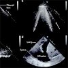 Echocardiography and Lung Ultrasonography for the Assessment and Management of AHF