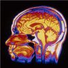 Intracranial Pressure Thresholds in Severe Traumatic Brain Injury: Pro