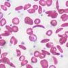 New Sickle Cell Test Can Transform Screening