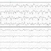 Rapid Bedside Evaluation of Seizures in the ICU by Listening to the Sound of Brainwaves