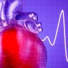 Surviving Refractory Out-of-Hospital Ventricular Fibrillation Cardiac Arrest
