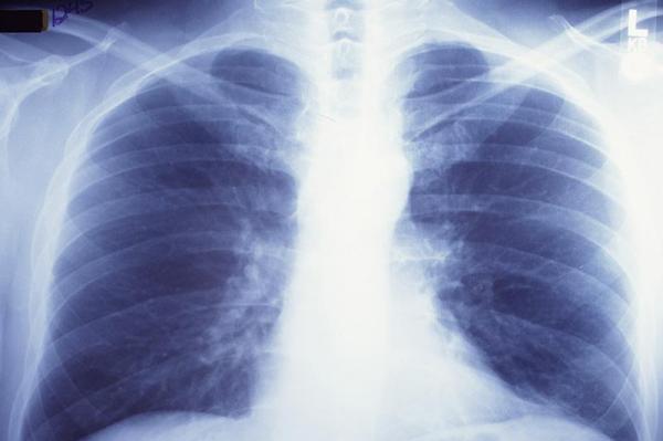 New technique keeps donor lungs viable longer