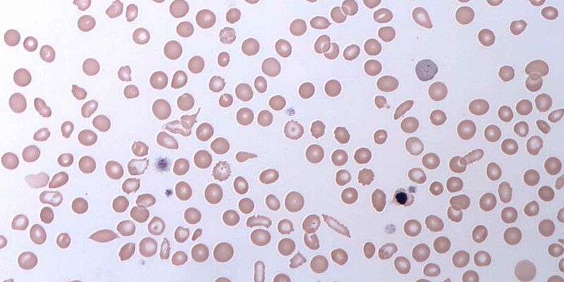 Crizanlizumab use lowers rates of sickle cell crises