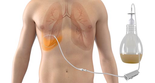 Catheter System Drains Recurrent Pleural Effusions