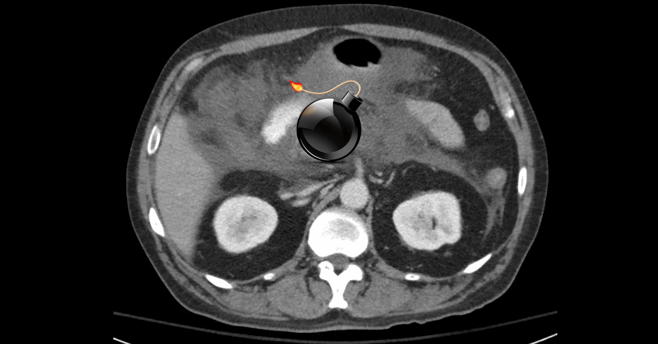 Hypertriglyceridemic pancreatitis: Can we defuse the bomb?