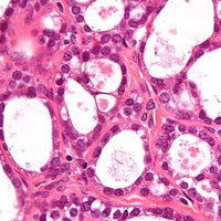 New Ecosystem Test Strongly Predicts Ovarian Cancer Survival