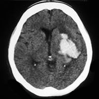 Outcomes and Costs of Patients Admitted to the ICU Due to Spontaneous Intracranial Hemorrhage