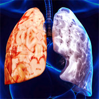 a-simple-algorithm-for-the-identification-of-clinical-copd-phenotypes
