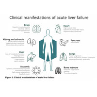 Acute Liver Failure: Evidence-Based Evaluation and Management