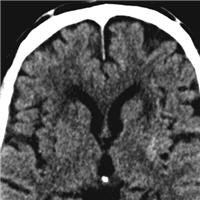 admission-hemoglobin-levels-are-associated-with-functional-outcome-in-spontaneous-intracerebral-hemorrhage