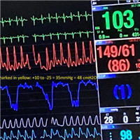 Assess the Intensity of Inspiratory Efforts Using CVP Waveforms
