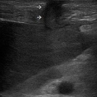 bedside-percutaneous-ultrasound-gastrostomy-tube-placement-by-critical-care-physicians