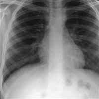 benchmarking-saliency-methods-for-chest-x-ray-interpretation