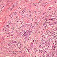 Biopsy first: Lessons learned from CALGB 140503
