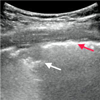 Can Ultrasound Predict Histologic Pattern of Lung Injury in COVID‑19 patient?