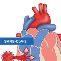 Cardiac Injury in COVID-19