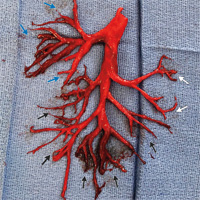cast-of-the-right-bronchial-tree