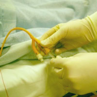 catheter-safeguards-at-hospitals-reduce-infections