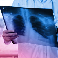 Chest Radiography vs. Lung Ultrasound for Identification of ARDS