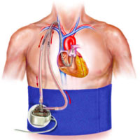 choosing-the-appropriate-configuration-and-cannulation-strategies-for-ecmo