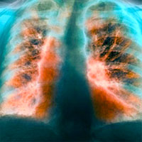 Clinical Impact of COPD on Non-cystic Fibrosis Bronchiectasis