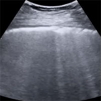 Clinical Utility and Technique for Lung Ultrasound in COVID-19 Cases