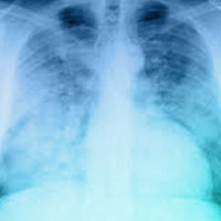 comparison-of-alveolar-recruitment-strategies-for-preventing-postoperative-pulmonary-complications