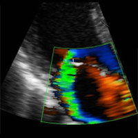 Comparison of Echocardiographic Indices of RVEF in Critically Ill Patients