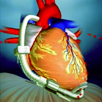 comparison-of-transplant-waitlist-outcomes-for-pediatric-candidates-supported-by-ventricular-assist-devices-versus-medical-therapy