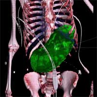 Computer Tomographic Assessment of Gastric Volume in Major Trauma Patients