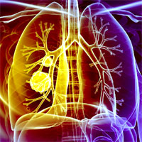 COPD and Life Expectancy