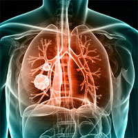 COPD can increase risk of developing sepsis