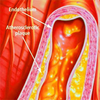 Coronary Endothelial Function and Spontaneous Coronary Artery Dissection