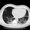 COVID-19 Pneumonia: ARDS or Not?