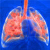 Critical COVID-19 Pneumonia Determinants