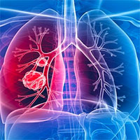 detection-of-pulmonary-embolism-during-cardiac-arrest