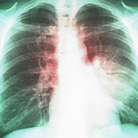 Diagnosis of Nonventilated Hospital-acquired Pneumonia