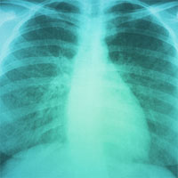 Distinguishing Pneumonia From Pneumonitis to Safely Discontinue Antibiotics