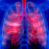 Pulmonary Infections Complicating ARDS