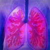 Why COVID-19 Pneumonia is More Deadly than Typical Pneumonia