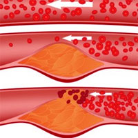Does Preoperative Troponin Level Impact Outcomes Following Coronary Artery Bypass Grafting?