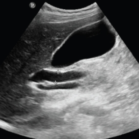 Doppler Ultrasound Identified Venous Congestion in Septic Shock