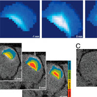 Early Detection and Monitoring of Cerebral Ischemia Using Calcium-Responsive MRI Probes