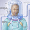 Effect of Helmet Noninvasive Ventilation vs. High-Flow Nasal Oxygen in Patients with COVID-19
