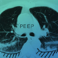 Effect of Lung Recruitment and Titrated PEEP vs Low PEEP on Mortality in Patients with ARDS