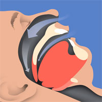 effect-of-obstructive-sleep-apnea-treatment-on-renal-function